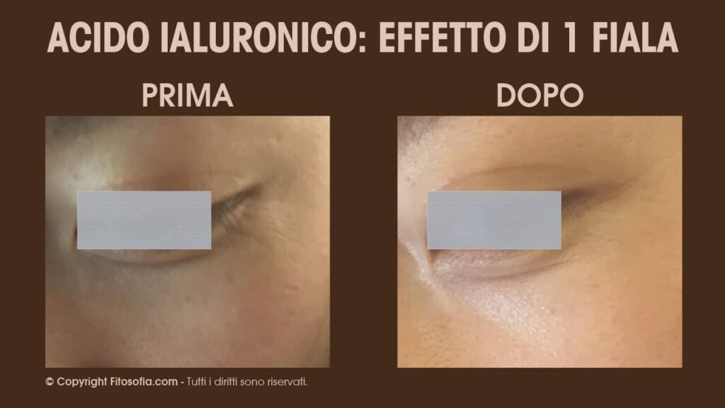 acido ialuronico prima e dopo l'applicazione