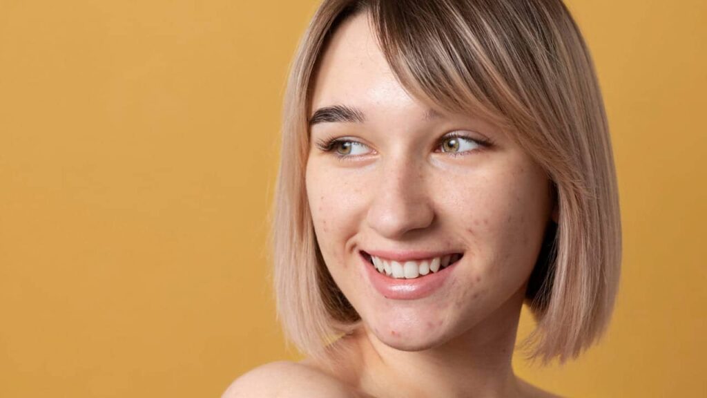 Acne giovanile come sbarazzarsene