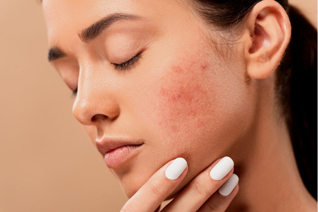 Che cos'è l'acne ormonale femminile