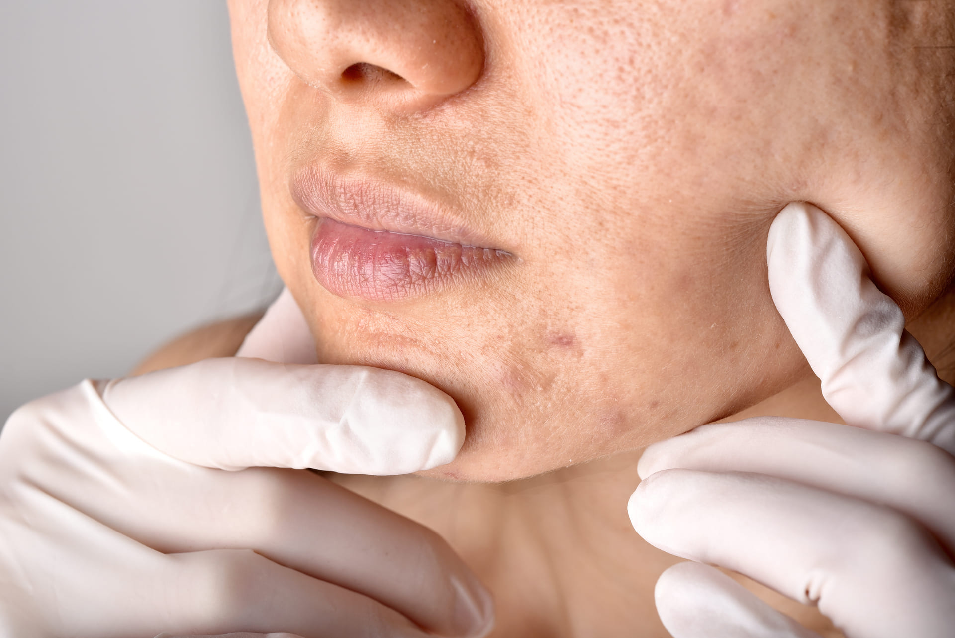 Ultime ricerche scientifiche sull'acne giovanile