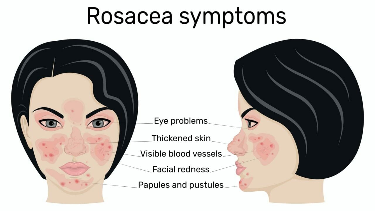 sintomi acne rosacea immagine